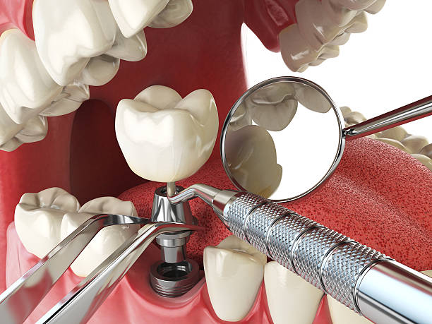 Best Lost Filling or Crown Replacement in Warrensville Heights, OH
