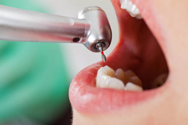 Best Knocked-Out Tooth (Avulsed Tooth) Treatment in Warrensville Heights, OH